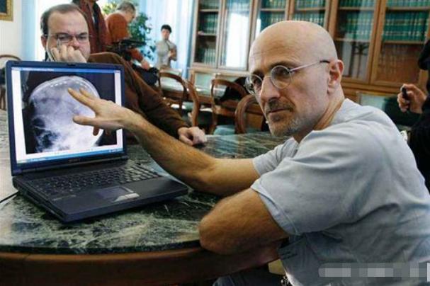 世界上首例成功的“换头手术”，耗时18小时花费7千万，现状如何