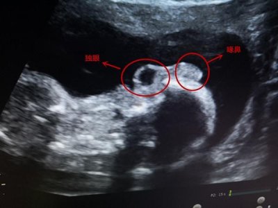 ​独眼喙鼻（产检发现畸形儿一只眼鹰钩鼻形似外星人）