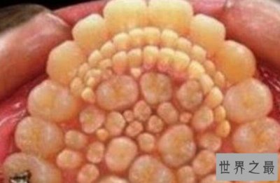 ​世界上牙齿最多的人,竟然长出了37颗牙！