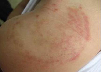 身上出癣的初期图片 女性体癣初期图片