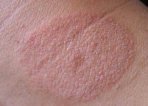 身上出癣的初期图片 女性体癣初期图片