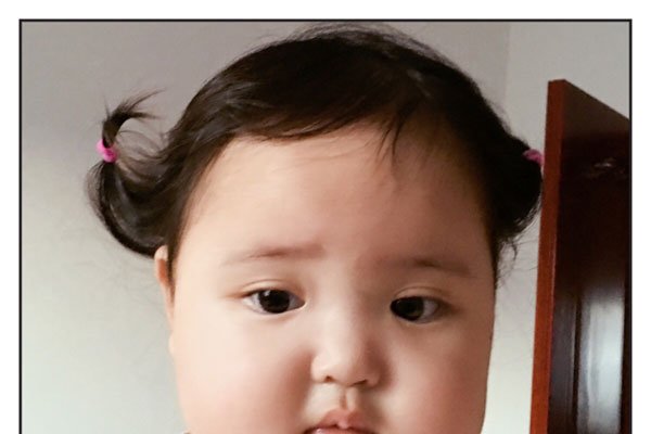 小刚几手指是什么病 巨指症妈妈说是被门夹了