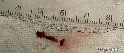 ​溶栓取栓治疗(溶栓“神药”溶栓后，为什么还要手术取栓？)