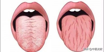 ​舌头有裂纹，究竟是身体出了什么问题？今天沈医生一次给你讲明白