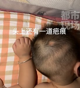 ​双胞胎出生后浑身淤青？原来是因为在肚子里“拳打脚踢”