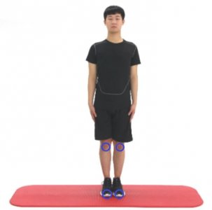 ​外八字的定义与成因分析